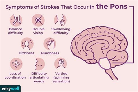 Stroke And The Pons Region Of The Brain
