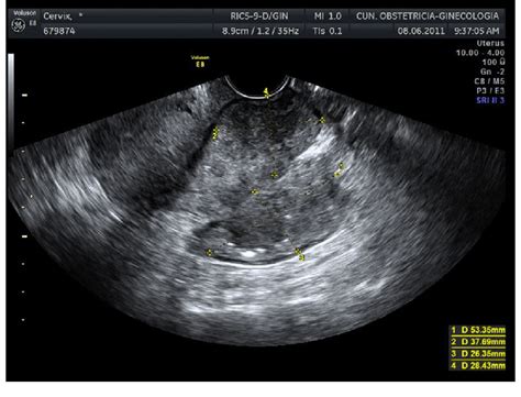 Transvaginal Ultrasound Showing A Large Cervical Cancer In Longitudinal