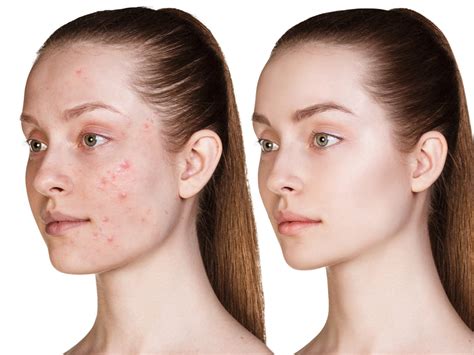 Laser Acne Treatment Baton Rouge La Body Image Aesthetics