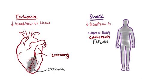Cardiogenic Shock Signs And Symptoms Hot Sex Picture