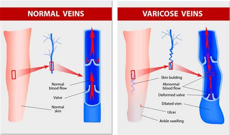 Venous Valves Anatomy