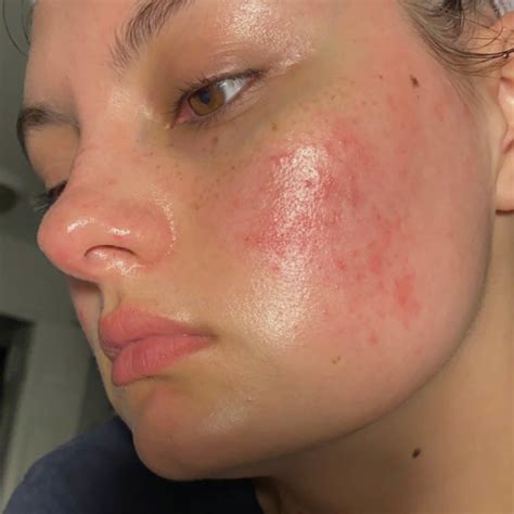 Dermatologist Approved Skincare Tips And Products For Rosacea Curology