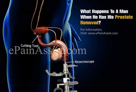 What Side Effects Does Having Your Prostate Removed Bobby Vincent S Blog