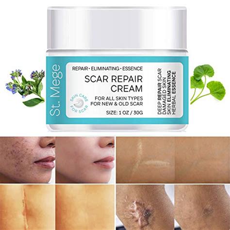 15 Best Scar Removal Creams Of 2023 Reviews Buying Guide