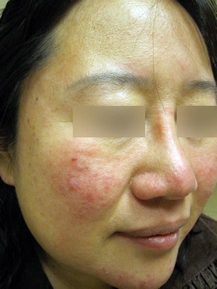 Rosacea With Flushing And Facial Redness Acne And Rosacea Society Of