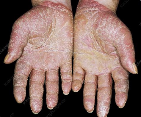 Albums 90 Pictures Psoriasis On Palms Of Hands Pictures Stunning