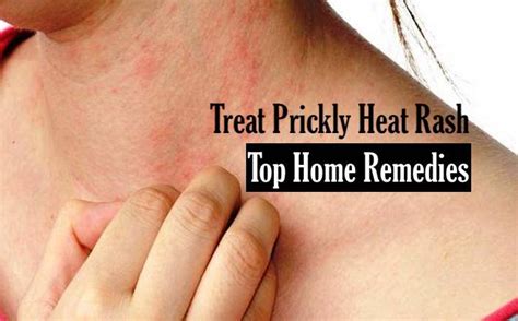 fine beautiful info about how to get rid of heat rash assistancecorporation