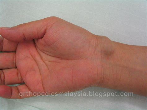 Ganglion Cyst Swelling In The Wrist The Orthopedics Malaysia Blog