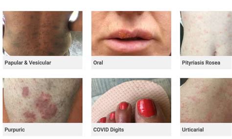 Covid 19 Skin Rash Website Criticised For Lack Of Bame Examples