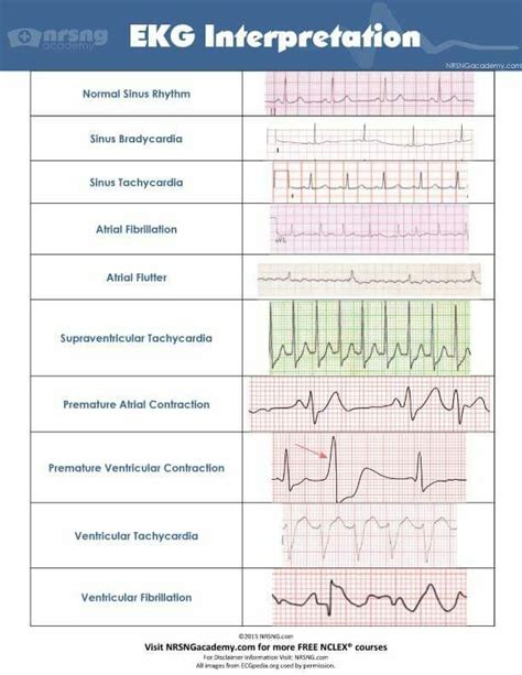 A complete guide to systematic ecg interpretation; EKG strip interpretation | Nursing school, Ekg interpretation, Nurse