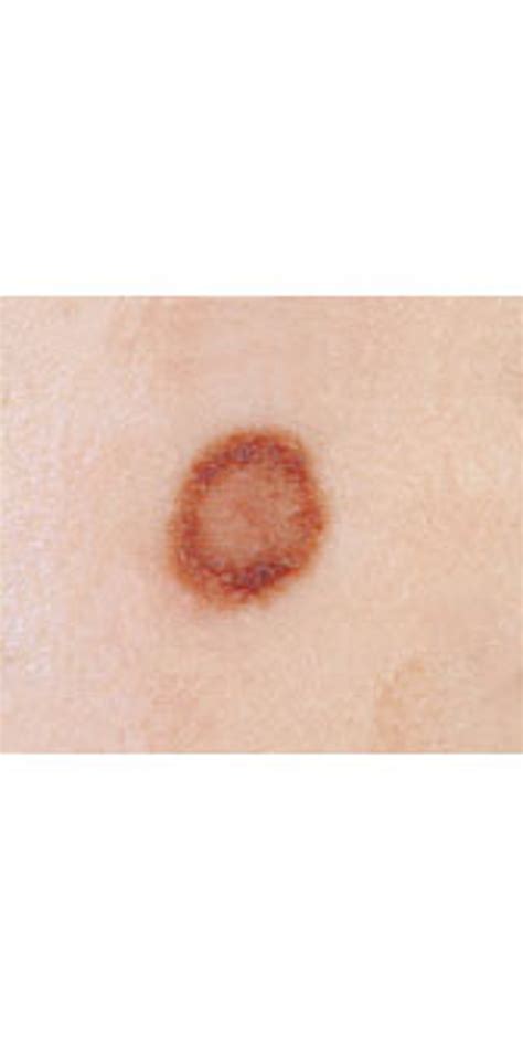 Signs Of Skin Cancer This Skin Check Can Save Your Life Glamour