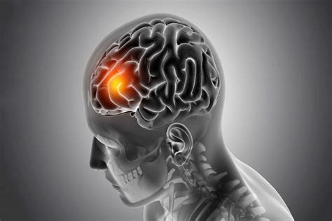 What Diseases Can Cause Lesions On The Brain What Is The Most Common