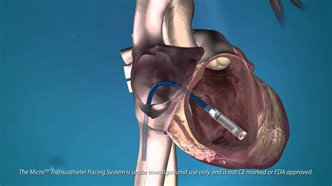 The Medtronic Micra—the Worlds Smallest Pacemaker Is Implanted In The