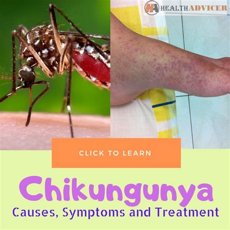 Chikungunya Causes Picture Symptoms And Treatment
