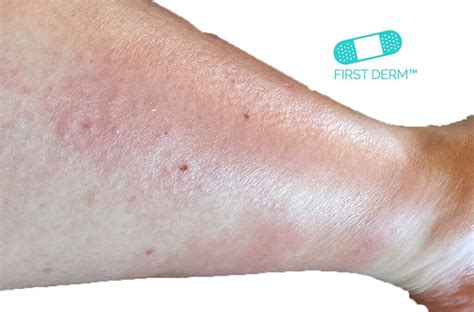 Online Dermatology Itchy Red Rash And Spots On Your Skin What Could