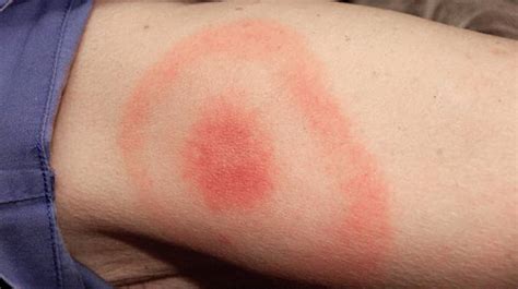 People With Bullseye Rash Should Be Immediately Treated For Lyme