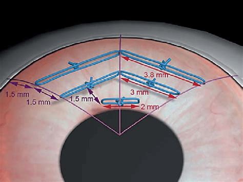 Suture Placement Pattern Following An Inverted Triangle Fig 2