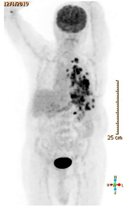 Figure 1 From Lung Adenocarcinoma With Paraneoplastic Hyper