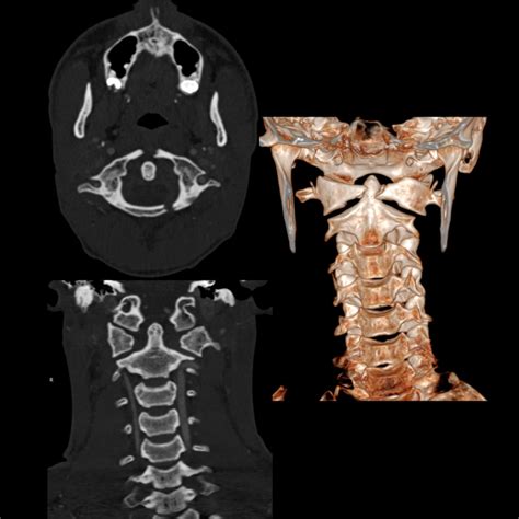 Pediatric Cervical Spine Fracture Pediatric Radiology Reference