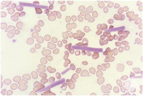 Cryoglobulinemia Presenting With Crystals In Peripheral Blood