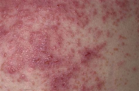 Dermatitis Herpetiformis Dermrounds Dermatology Network