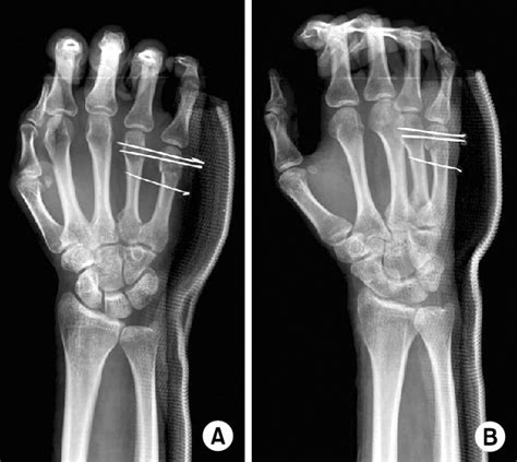 Figure 2 From Treatment Of 5th Metacarpal Neck Fracture Using