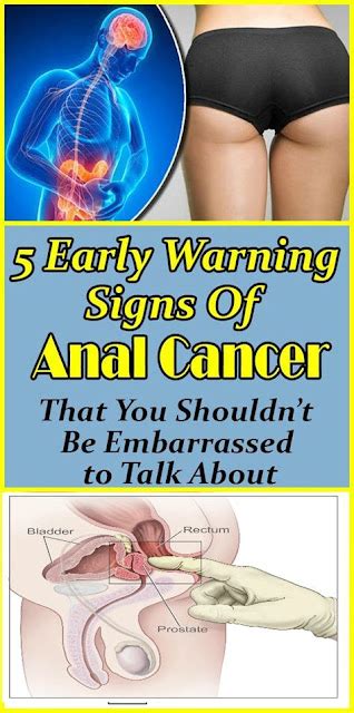 5 Early Warning Signs Anal Cancer That You Shouldnt Be Embarrassed To