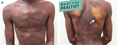 This Man Went To The Doctor For A Rash And It Turned Out He Had Hiv