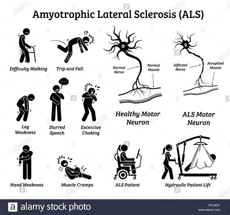 Als variants hereditary als primary lateral sclerosis primary muscular atrophy pseudobulbar paralysis flail arm. Amyotrophe Lateralsklerose als Krankheit Anzeichen und ...