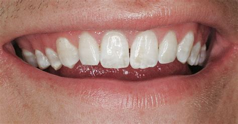 Treatment Of Mild To Moderate Fluorosis With A Minimally Invasive