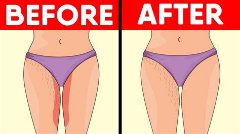 5 Natural Ways To Get Rid Of Thigh Rashes Youtube