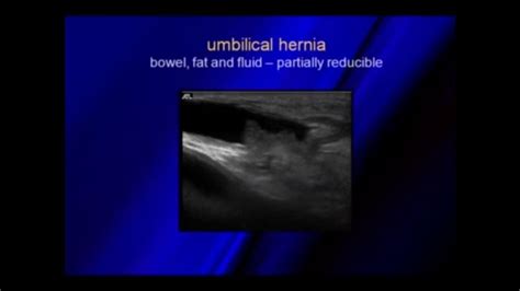 Ultrasound Of Hernias Umbilical Hernia Ultrasound Fluid