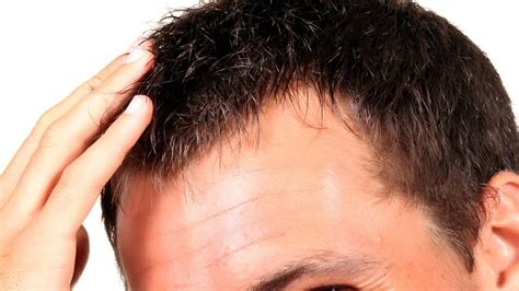Le congrès international sur la greffe de cheveux s’est tenu à Avignon