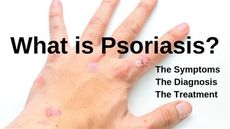 Understanding Psoriasis Symptoms And Treatment With Medication