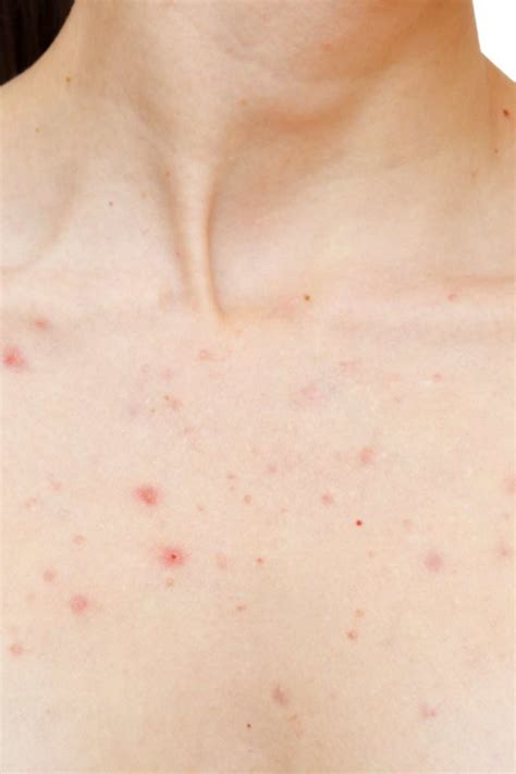 Acne Bumps On Chest