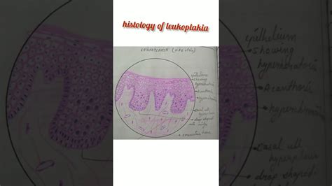Histology Of Leukoplakia Oral Pathology Bds 3rd Year Youtube