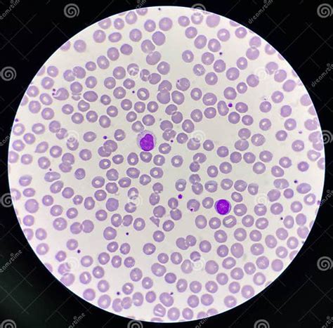 Normochromic And Normocytic Rbc Blood Smear Stock Image Image Of