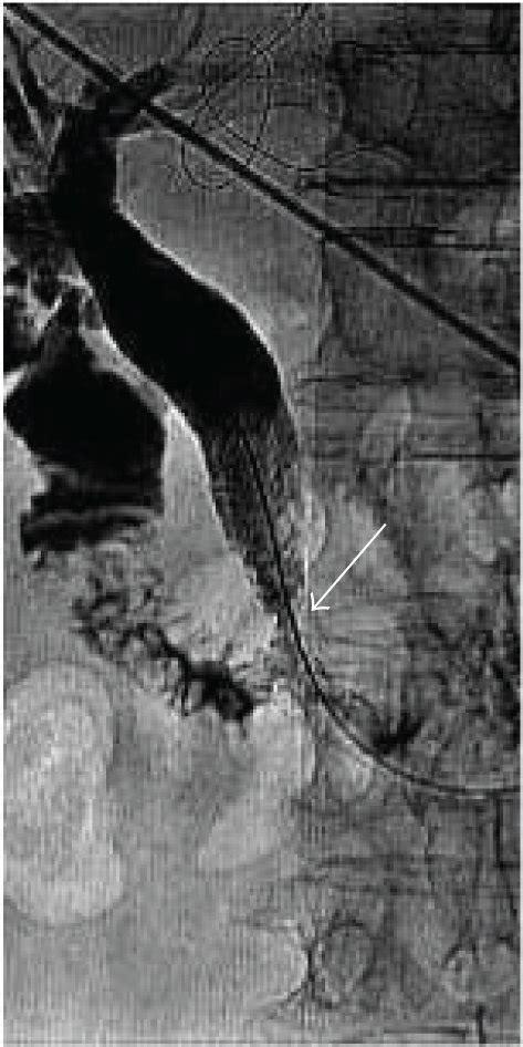 Gradual Fracture Of A Biliary Stent In A 78 Year Old Woman With Common