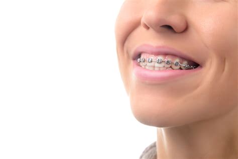 Everything you need to know. 5 Signs You May Need Braces - Belmar Orthodontics