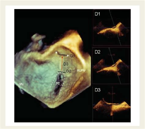 Dimensions Of A Patent Foramen Ovale Threedimensional Transoesophageal