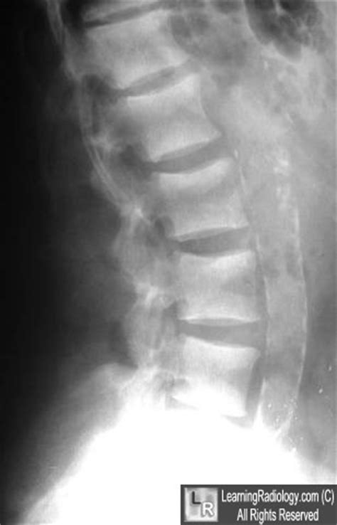 The mechanism of injury is hyperextension, such as pulling on the jersey of a football opponent running away from you, or in this. LearningRadiology-MSK Image Gallery