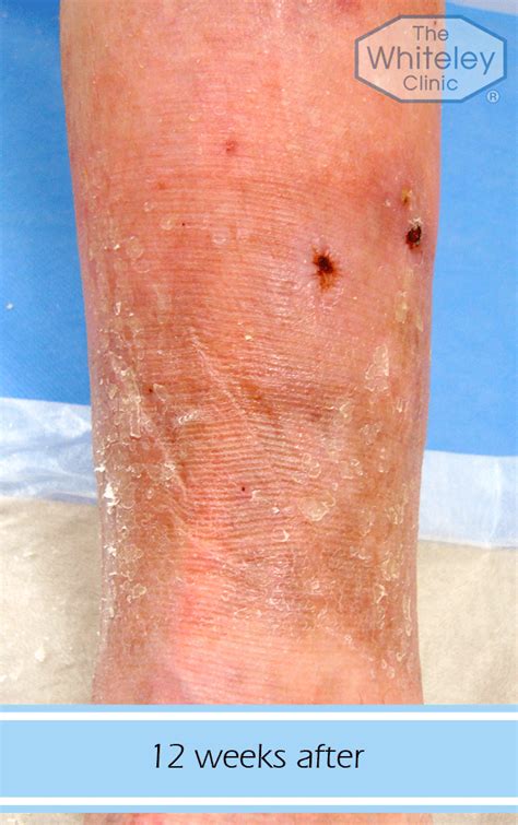 Permanent Cure For Leg Ulcers