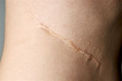 Surgery Scar After Kidney Pyelonephritis After Remove Kidney Operation