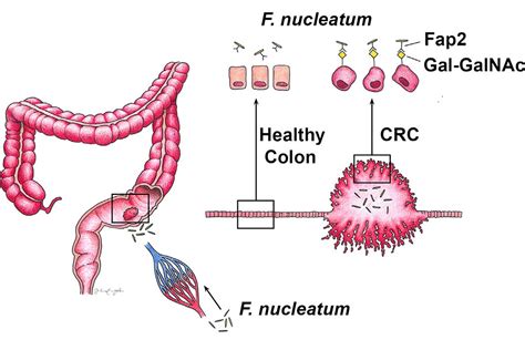 How Mouth Microbes May Worsen Colorectal Cancer