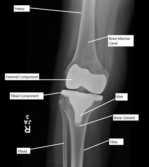 Complications After Total Knee Replacement General Ce