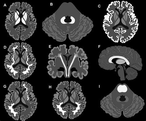 Imaging Patterns Of Toxic And Metabolic Brain Disorders Radiographics