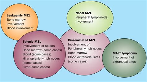 Splenic Marginal Zone Lymphoma A Distinct Clinical And Pathological