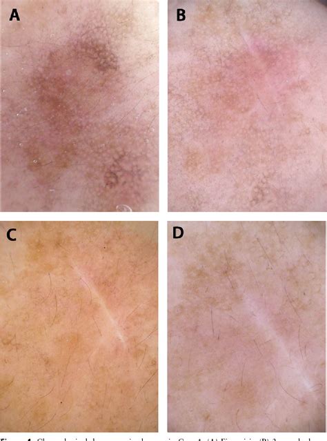 Figure 1 From Chronology Of Lichen Planus Like Keratosis Features By