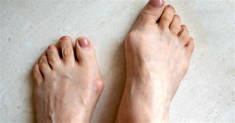 Foot And Ankle Problems By Dr Richard Blake Big Toe Joint Pain At