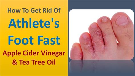 How To Get Rid Of Athletes Foot Fast Apple Cider Vinegar And Tea Tree
